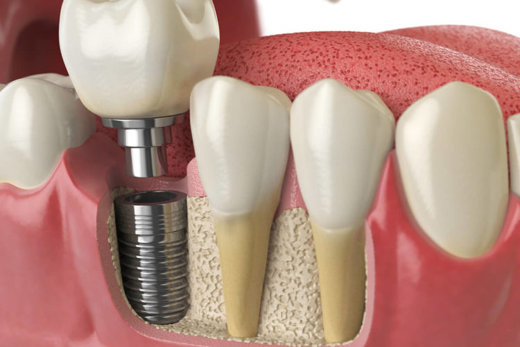 Implantes Dentários - Ozawa & Kakizawa Odontologia