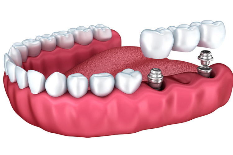 Prótese sobre Implante - Ozawa & Kakizawa Odontologia